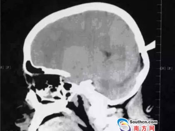 女童放学路上 被飞镖插后脑  医生跪地麻醉保平