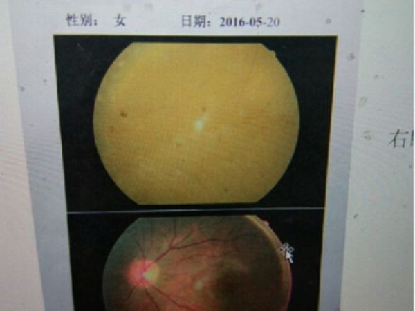 辽23岁女孩民房注射 玻尿酸  10秒后 双眼失明 