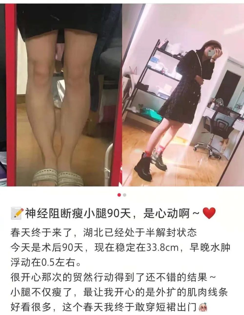 为了减肥有人把手术刀伸向了小腿神经